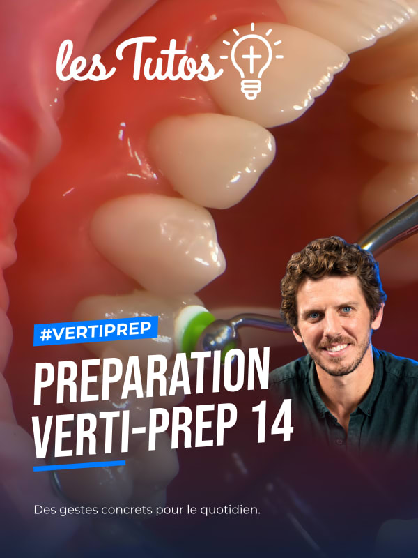 Preparation verti-prep 14 (Tuto, saison 2 épisode 20) : Démonstration muette du Dr Hugues de Belenet : une préparation Verti-Prep sur la prémolaire…