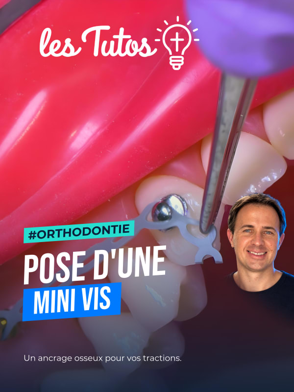 Pose d'une mini vis (Tuto, saison 2 épisode 32) : Démonstration muette de Sébastien Nicolas et Guillaume Joseph : la pose d'une mini-vis d'ancrage…
