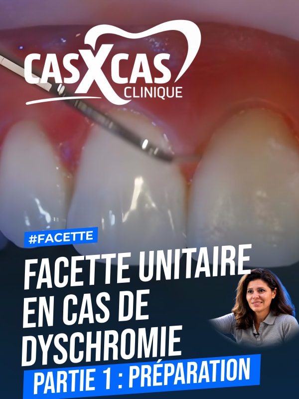Facette unitaire en cas de dyschromie partie 1 : préparation (Cas par Cas, saison 1 épisode 1) : Le Dr Stéphanie Ortet présente les techniques de…