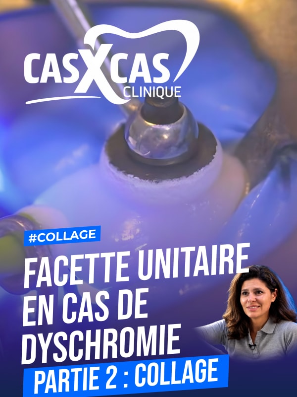 Facette unitaire en cas de dyschromie partie 2 : collage (Cas par Cas, saison 1 épisode 2) : Le Dr Stéphanie Ortet présente les techniques de…