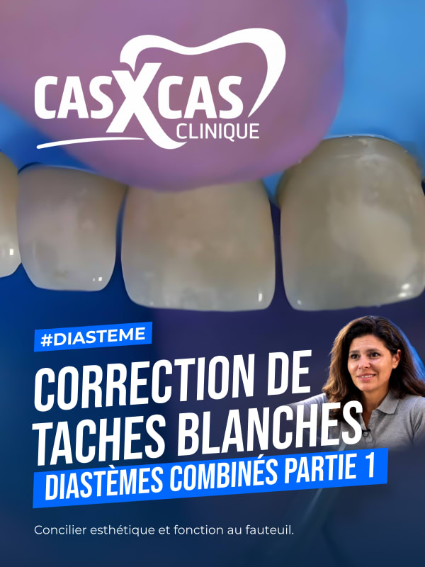 Cas clinique : correction de taches blanches et diastèmes combinés partie 1 (Cas par Cas, saison 1 épisode 4) : Le Dr Stéphanie Ortet aborde la…
