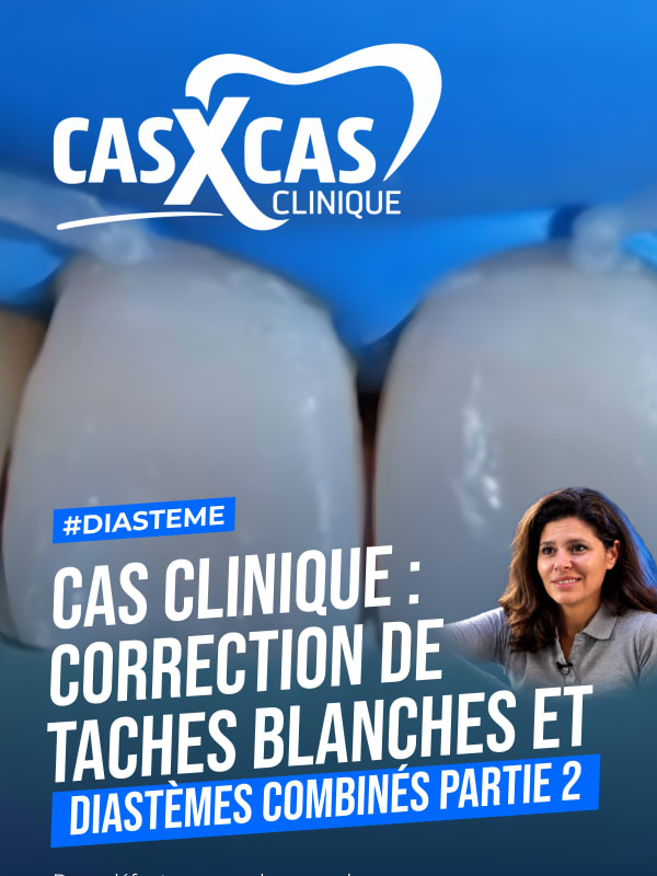 Cas clinique : correction de taches blanches et diastèmes combinés partie 2 (Cas par Cas, saison 1 épisode 5) : Le Dr Stéphanie Ortet aborde la…