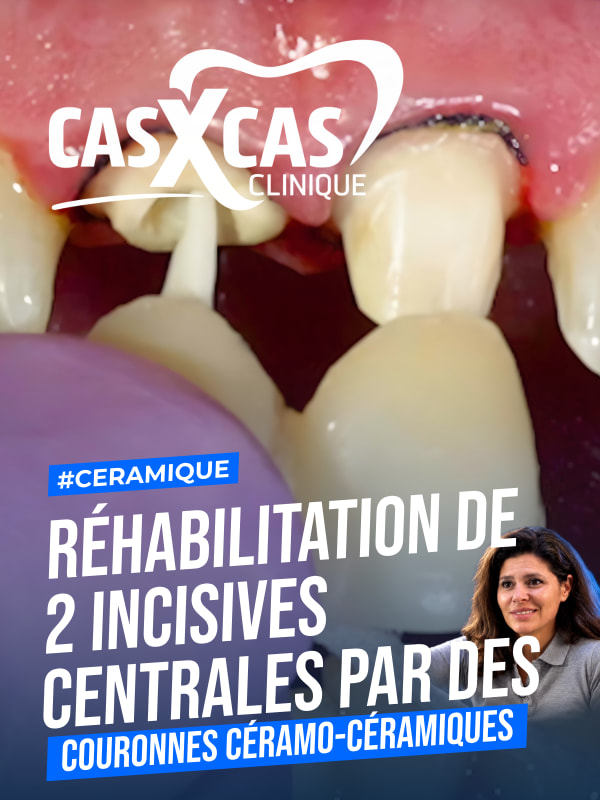 Cas clinique : réhabilitation de 2 incisives centrales par des couronnes céramo-céramiques (Cas par Cas, saison 1 épisode 6)