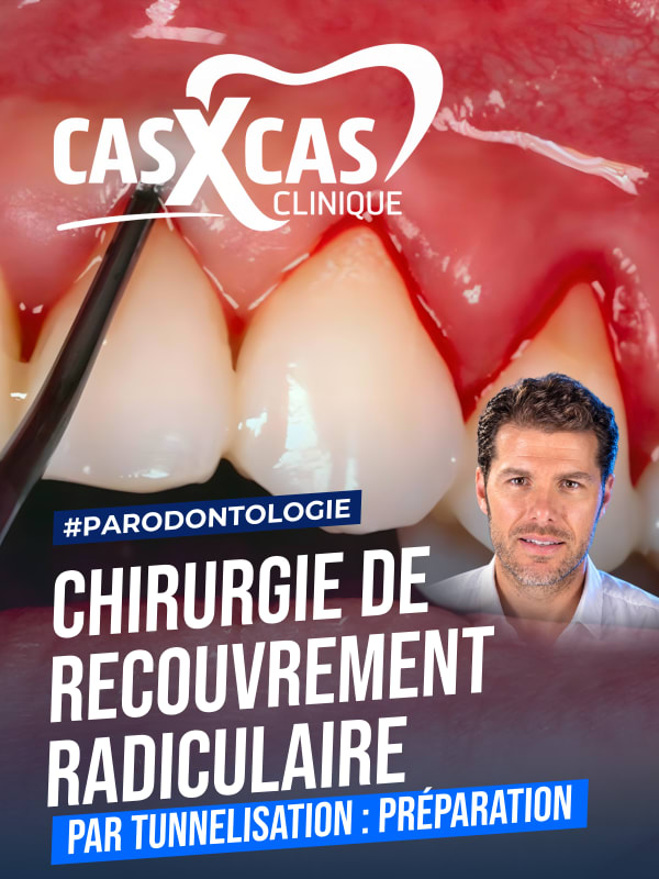 Chirurgie de recouvrement radiculaire par tunnelisation : préparation (Cas par Cas, saison 2 épisode 1) : Démonstration muette du Dr Benjamin Cortas…