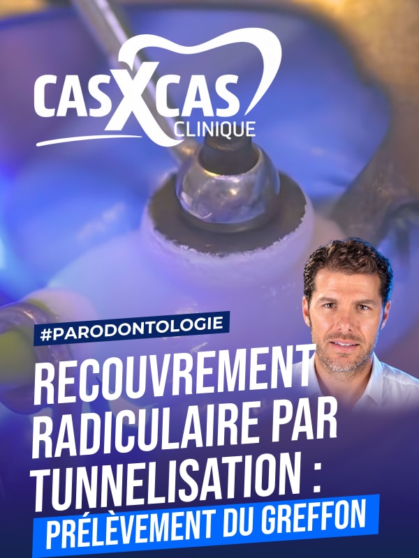 Chirurgie de recouvrement radiculaire par tunnelisation : prélèvement du greffon (Cas par Cas, saison 2 épisode 2) : Deuxième partie muette du Dr…