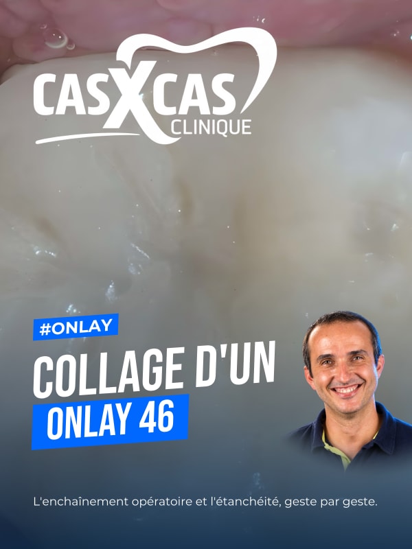 Collage d'un onlay 46 (Cas par Cas, saison 2 épisode 8) : Démonstration muette du Dr Gauthier Weisrock : le protocole de collage d'un onlay sur la…