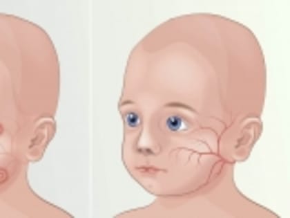 О мерах социальной поддержки больных фенилкетонурией