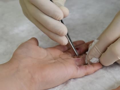 Врачи вернули ребенку возможность двигать пальцами на руках