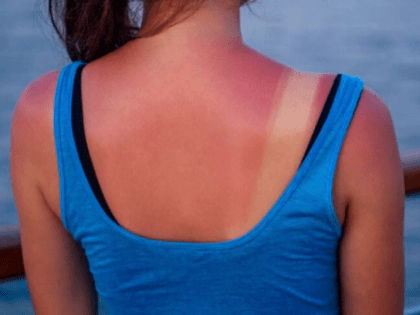 Из-за очень высокого индекса ультрафиолета можно получить ожоги на Ставрополье