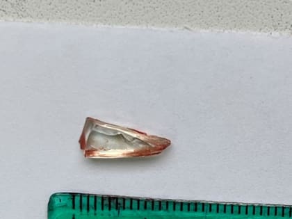 Коварное стекло: хирурги Ставропольской краевой клинической больницы извлекли из ноги пациентки осколок спустя четверть века после травмы