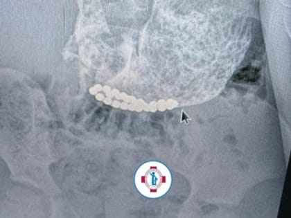 Магнитные шарики из желудка и кишечника извлекли ставропольские врачи у трех детей