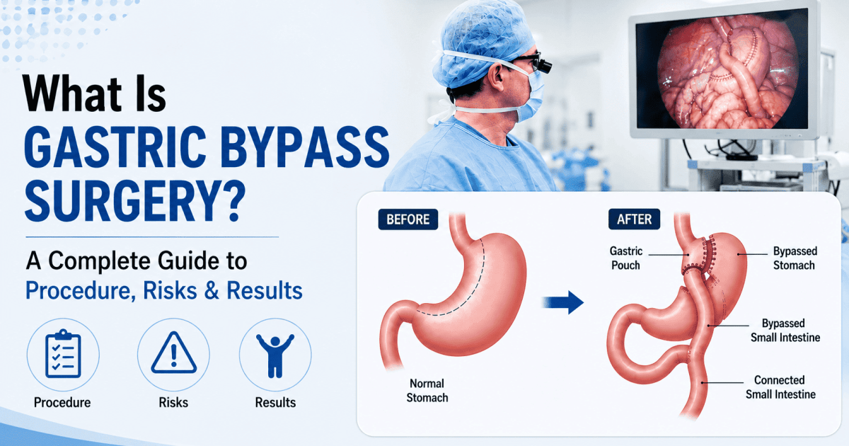 What Is Gastric Bypass Surgery? A Complete Guide to Procedure, Risks & Results