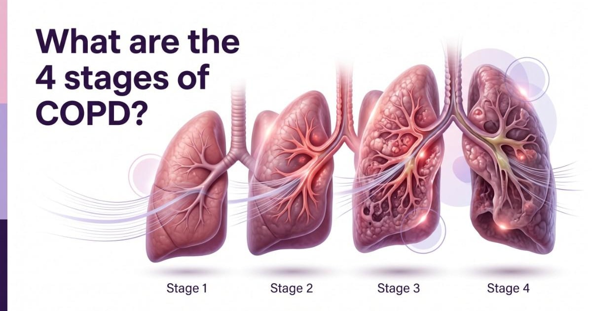 4 stages of COPD