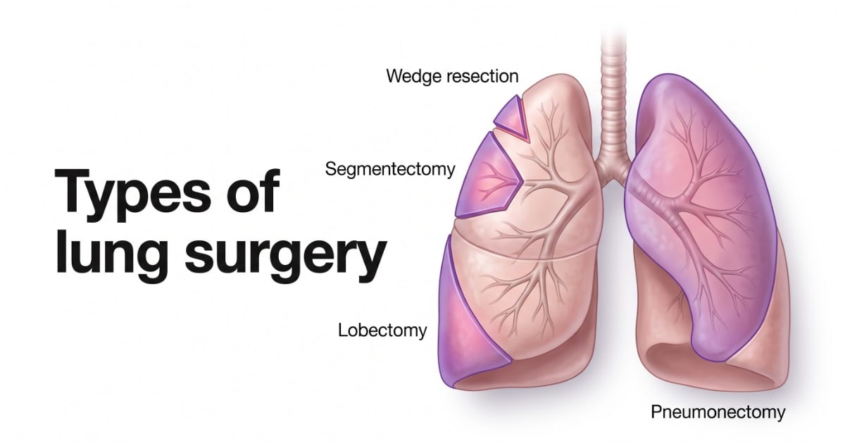 Types of lung surgery