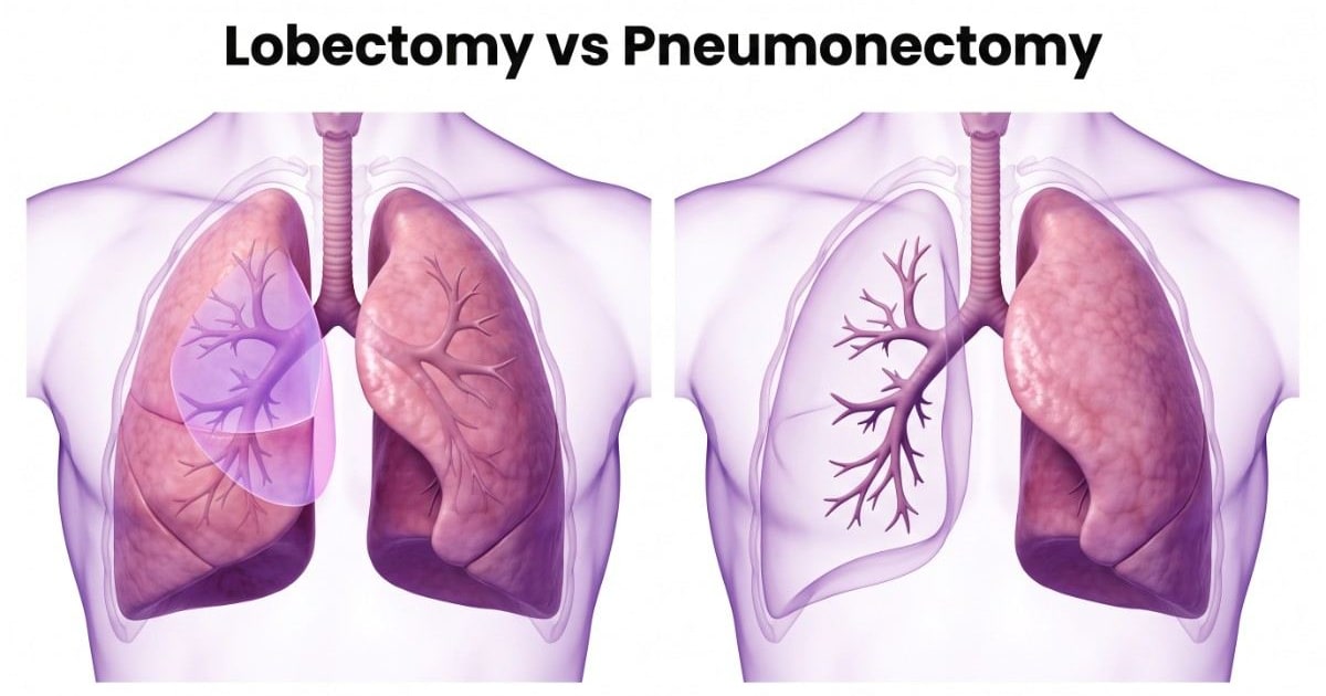 Lobectomy vs Pneumonectomy