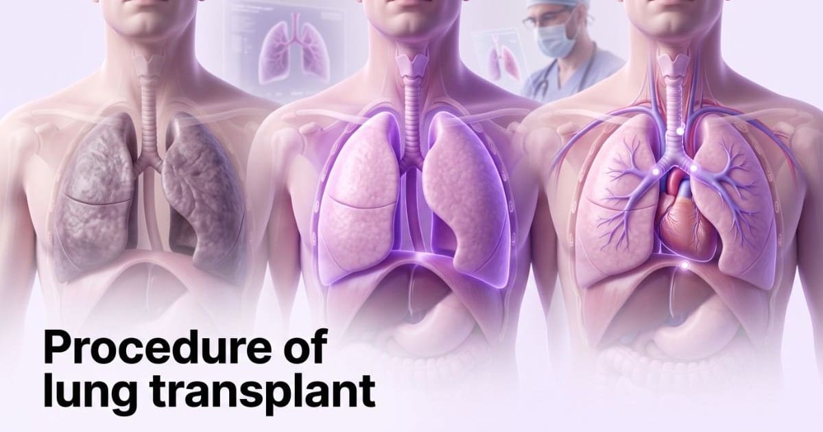 Procedure of lung transplant