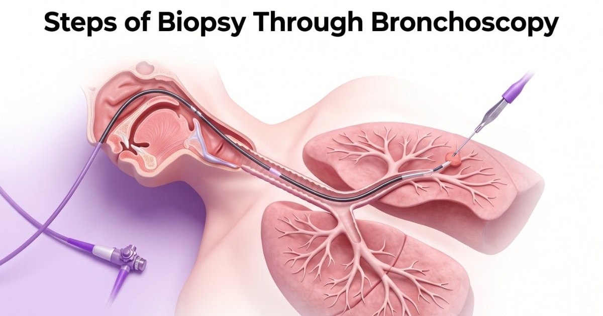 Biopsy through bronchoscopy