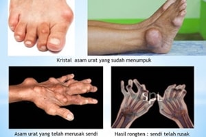 Ternyata Jeroan Bisa Menyebabkan Penyakit Asam Urat Ternyata Jeroan Bisa Menyebabkan Penyakit Asam Urat