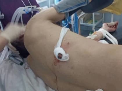 Арматура прошила насквозь мужчину в Приморье: врачи рассказали о состоянии пациента