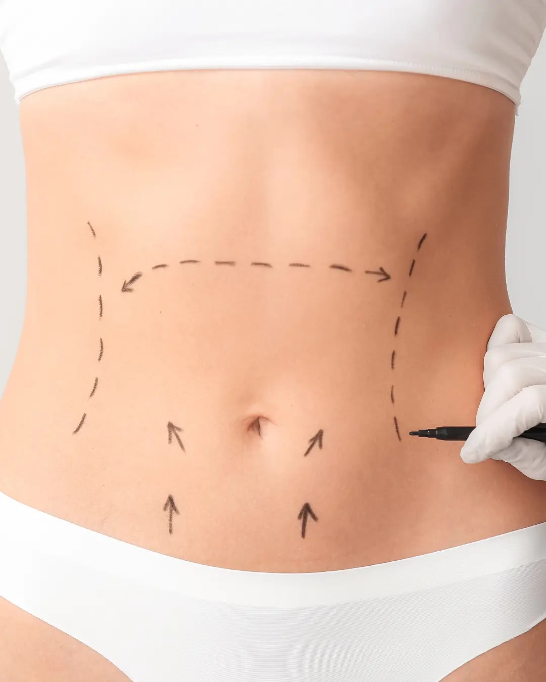 Paciente en consulta sobre abdominoplastia
