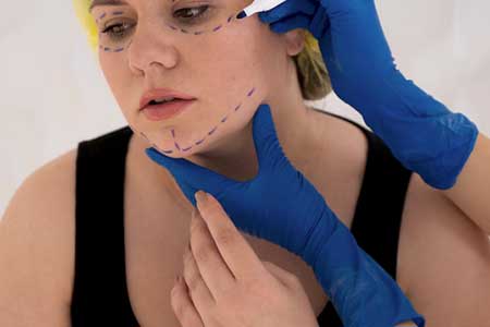 Hilos tensores cuello y mandíbula