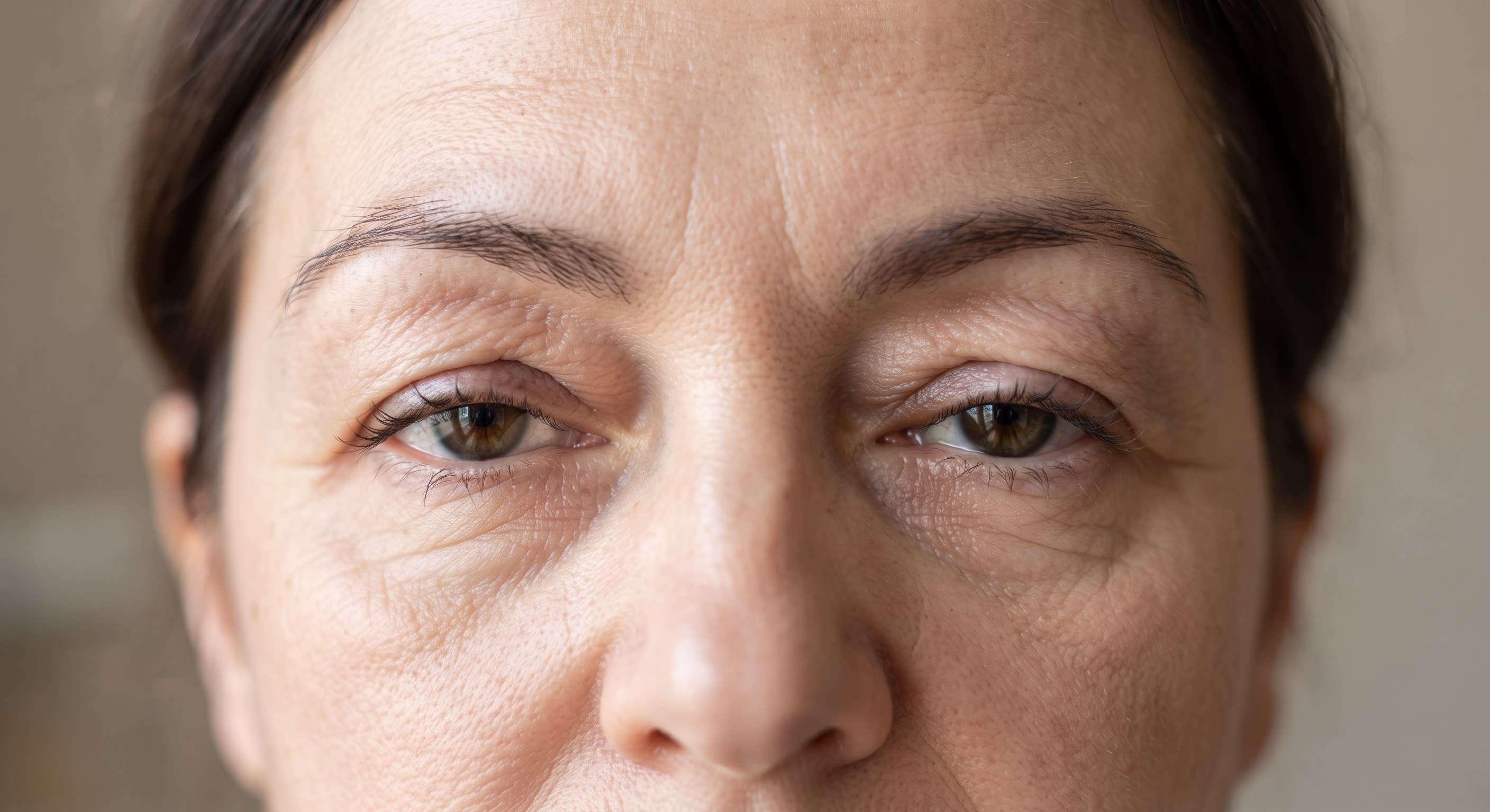 Exceso de piel en el párpado superior antes de una blefaroplastia en Burgos
