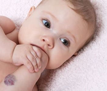 1895_bebe-angiome