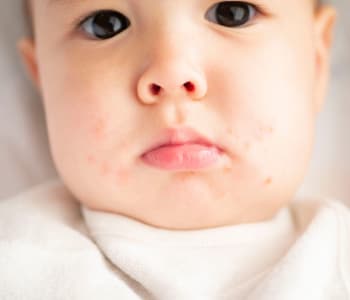 bébé avec des boutons autour de la bouche