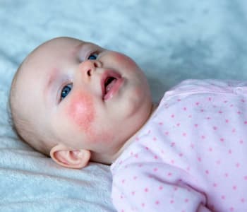 bébé a la roséole