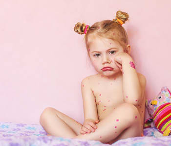 Bébé a la varicelle : comment la reconnaître et la soigner ?