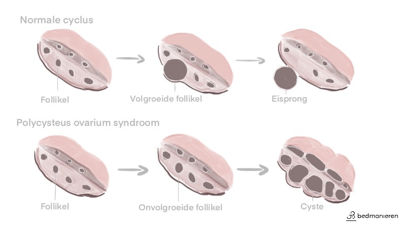 PCOS vs normale hormoonhuishouding