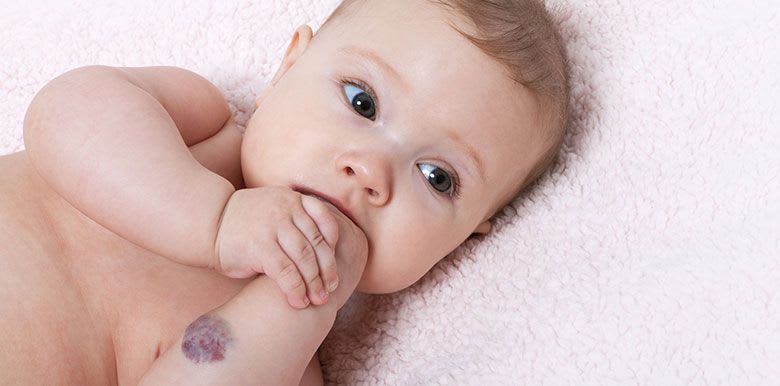 1895_bebe-angiome
