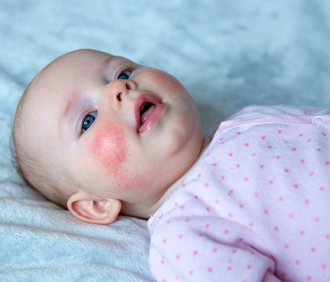 bébé a la roséole 