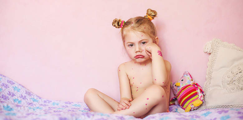 Bébé a la varicelle : comment la reconnaître et la soigner ? 