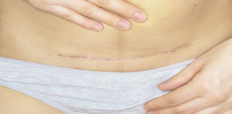 Césarienne : bien s'occuper de la cicatrice