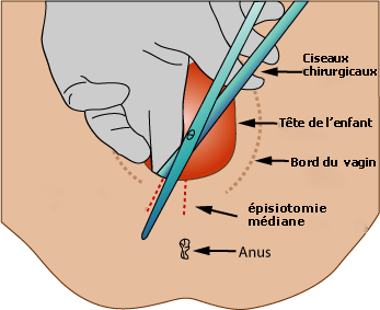 Medio lateral episiotomie