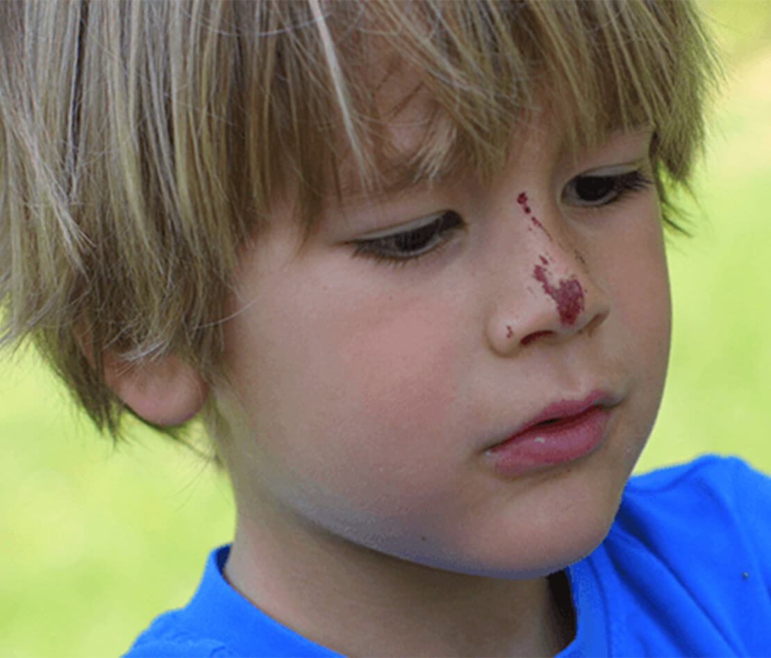 Bébé saigne du nez: saigner du nez chez le bébé