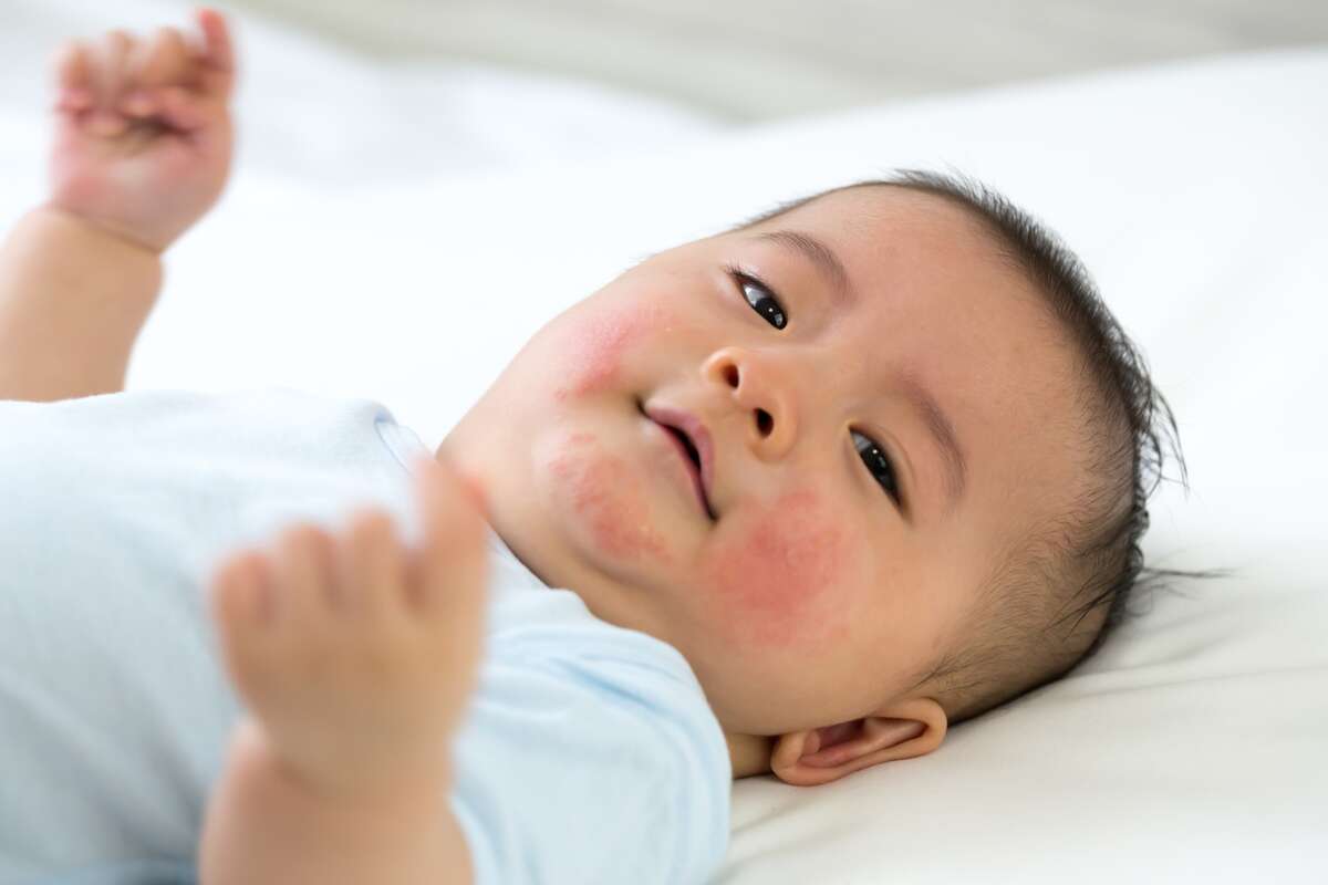 Urticaire bébé : reconnaître les symptômes et apprendre à la soigner