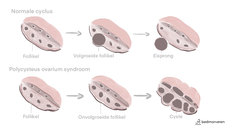 PCOS vs normale hormoonhuishouding