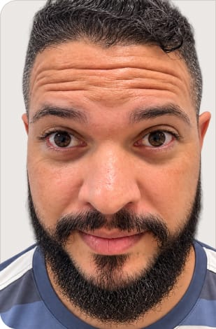 Antes - botox masculino