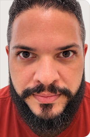 Depois - botox masculino