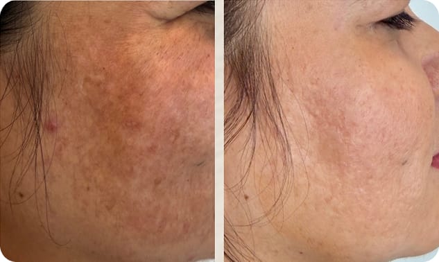 Antes e depois - tratamento de melasma