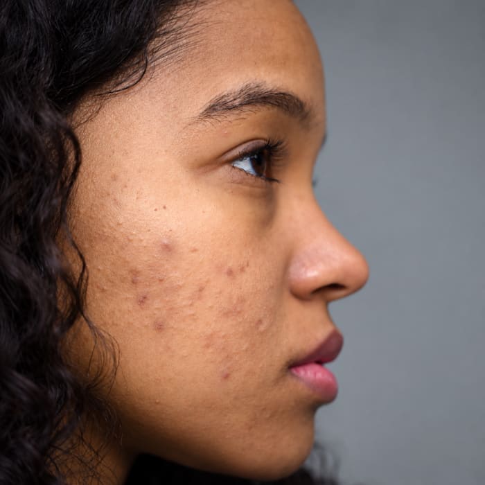 Tratamento de acne pela Dra. Daniele Murga