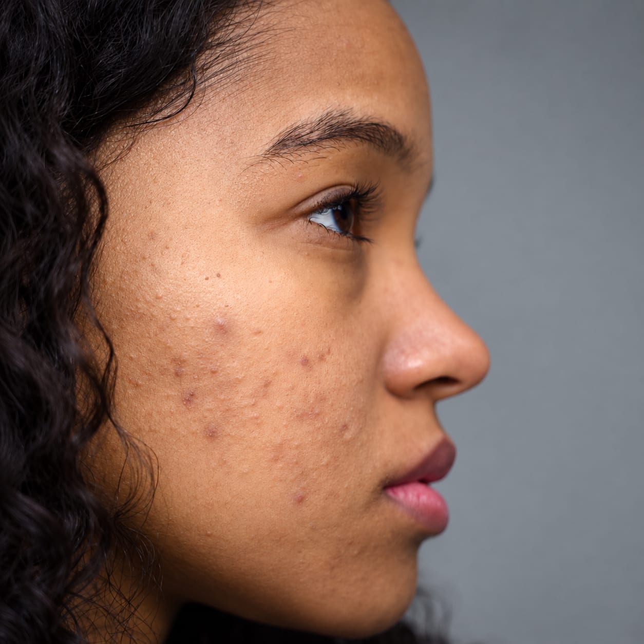Tratamento de acne pela Dra. Daniele Murga