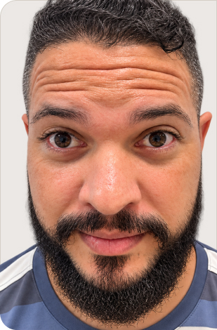 Antes - botox masculino