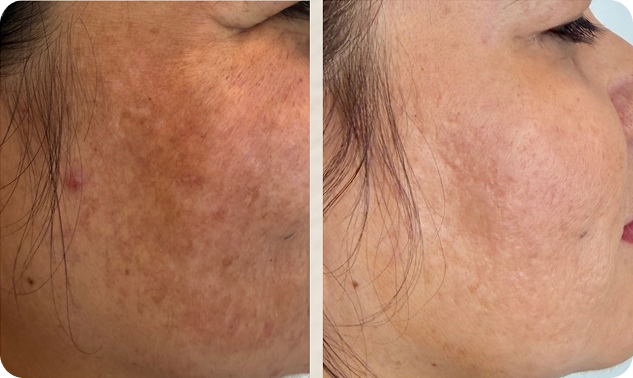 Antes e depois - tratamento de melasma