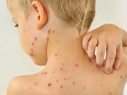 «Детская чума» возвращается?