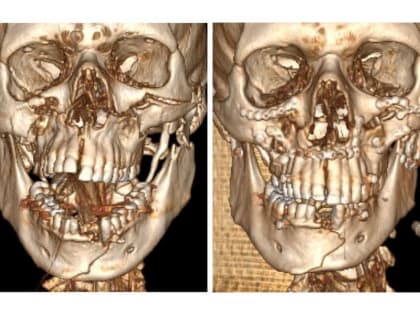 Врачи Хакасии восстановили лицо пациенту, серьезно пострадавшему в ДТП