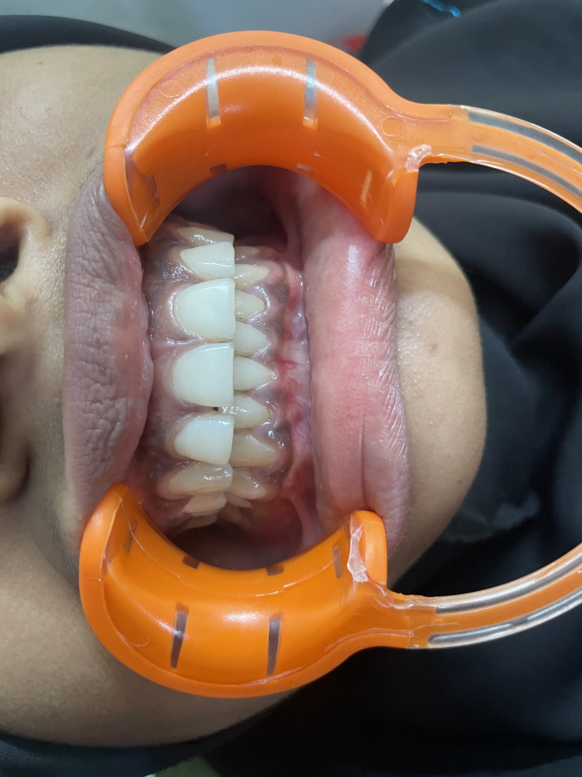 Composite Veneer