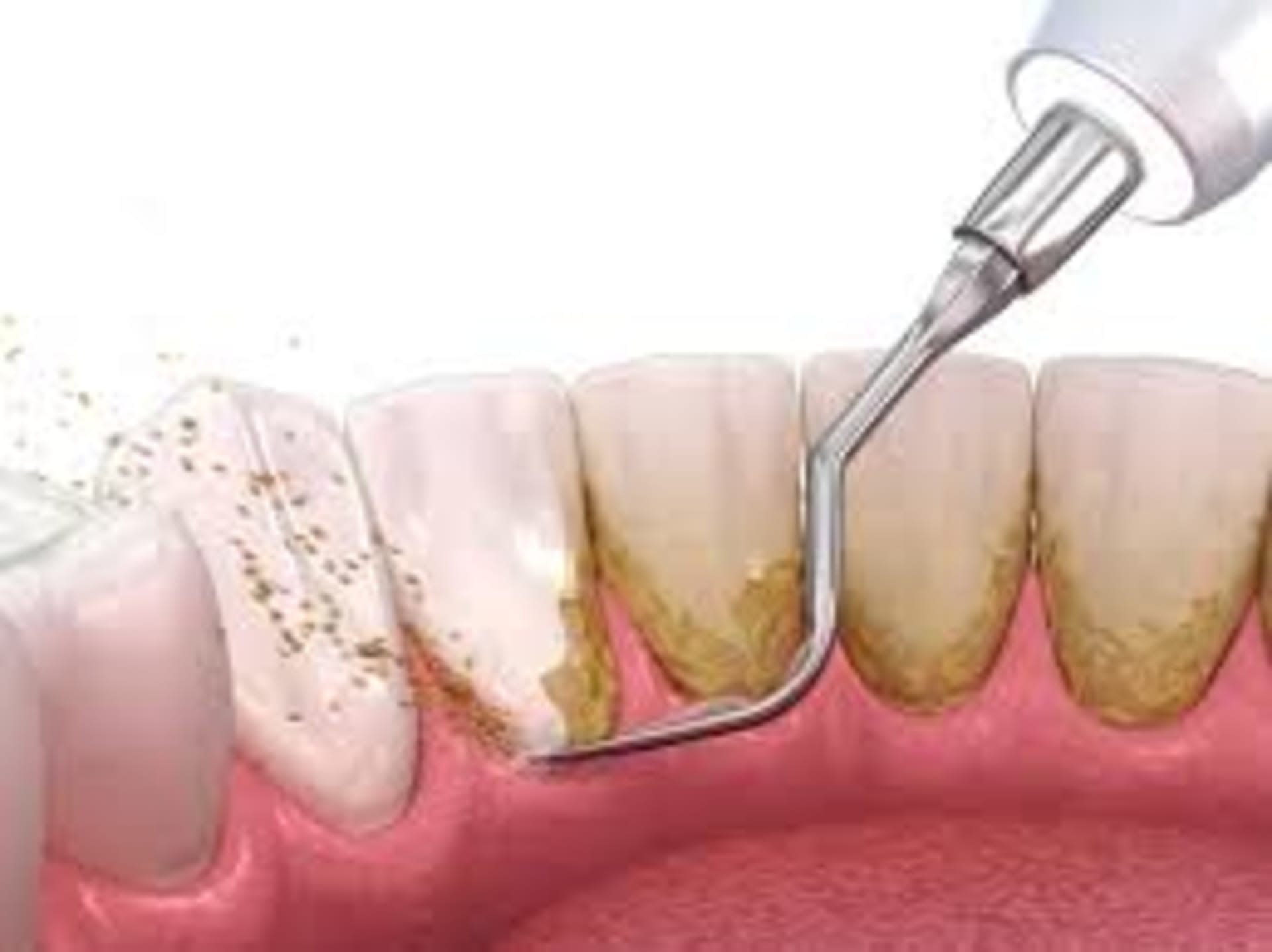Scaling Treatment in Dhaka - Smile Dental Care